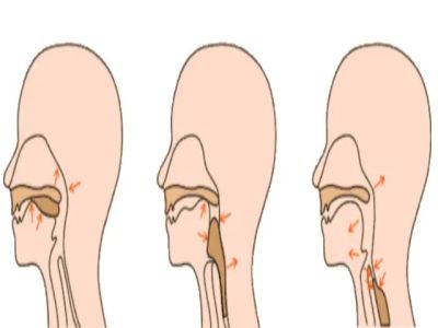 吞咽障碍训练方法
