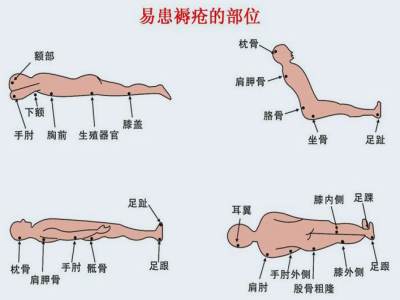 压疮易发部