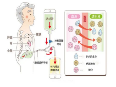 血透腹部